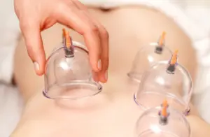 a registered massage therapist is performing cupping