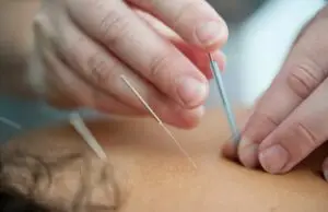 a registered massage therapist is performing acupuncture treatment
